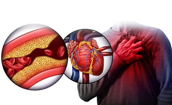 fatty liver and heart health MASLD cardiovascular risk coronary artery disease metabolic syndrome atherosclerosis