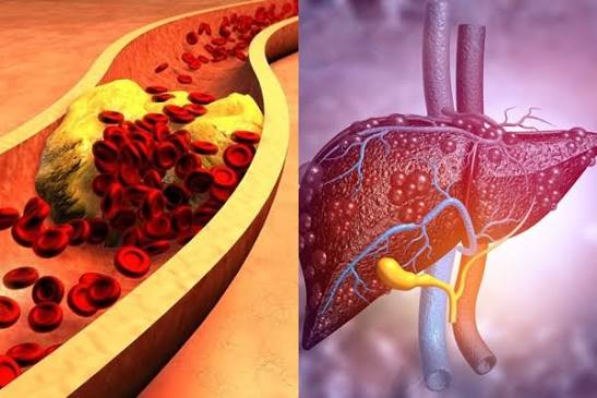 fatty-liver-high-cholesterol-body — MASLD statin safety liver enzymes cardiovascular risk triglycerides HDL LDL