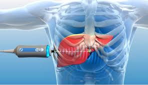 FibroScan a simple guide — transient elastography liver stiffness kPa fibrosis CAP score fatty liver