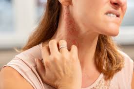 food intolerance vs food allergy key differences immune mechanism diagnosis management