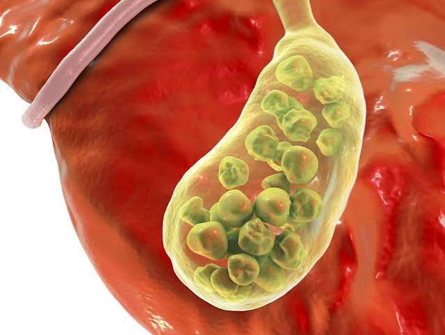 gallbladder health guide anatomy bile gallstones cholecystitis symptoms treatment cholecystectomy