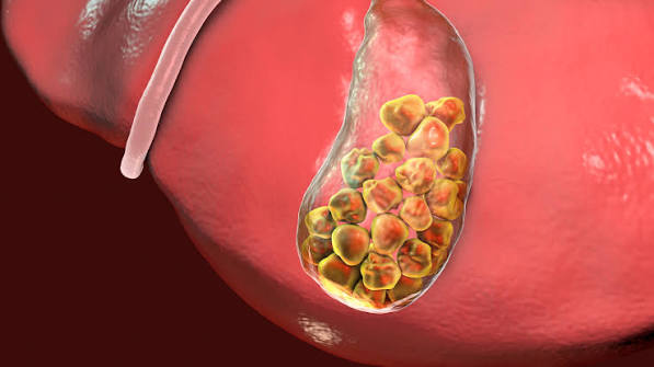gallstones diagnosis ultrasound biliary colic complications cholecystitis choledocholithiasis pancreatitis treatment