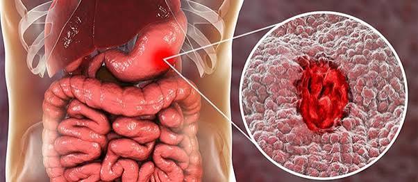 H. pylori gastritis endoscopy and treatment options including antibiotic eradication