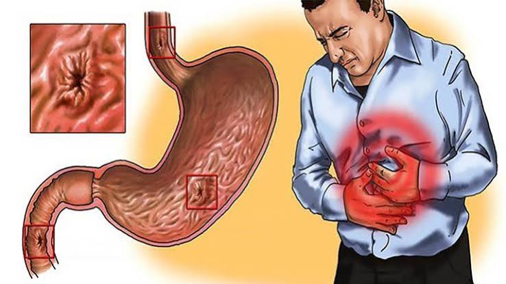 gastritis symptoms causes illustrated diagram of stomach lining inflammation