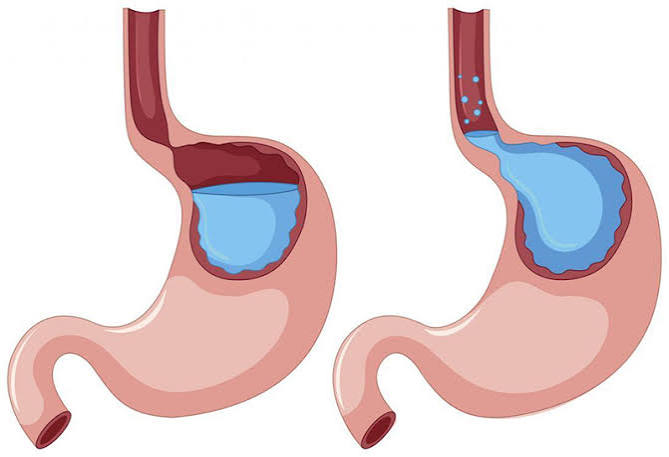 gerd-a-simple-guide-for-adults-body — GERD diagnosis and treatment guide showing endoscopy, lifestyle changes, and medications for adults