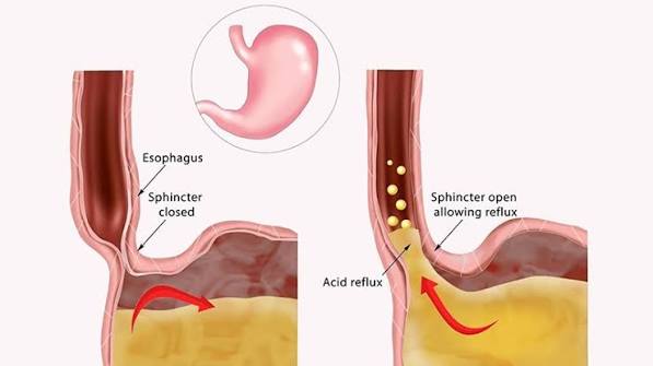 GERD vs gastritis difference oesophagus versus stomach inflammation comparison