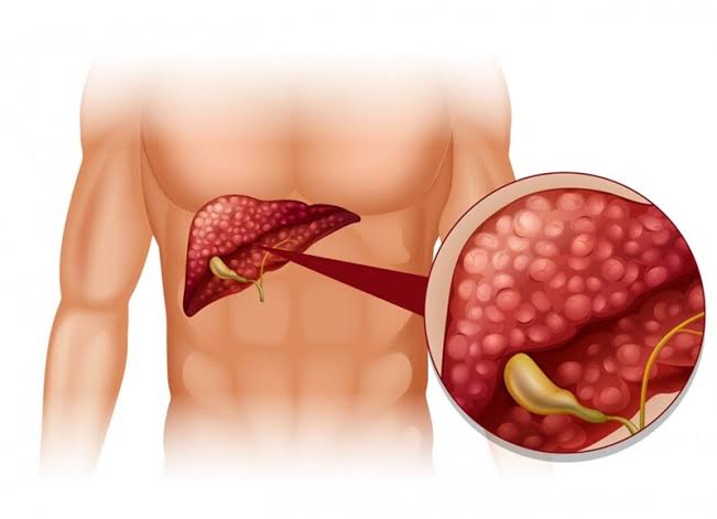 GGT-test-and-liver-health-body — GGT elevated alcohol liver disease MASLD cholestasis drug reaction