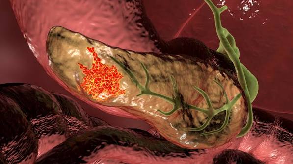 greasy-stool-what-adults-should-know-body — fecal elastase testing and pancreatic enzyme replacement for exocrine pancreatic insufficiency