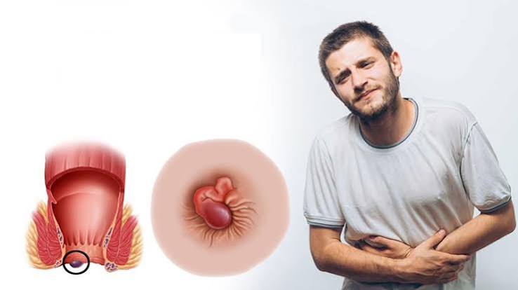 Medical illustration showing internal and external hemorrhoids in the anal canal with the dentate line marked, explaining hemorrhoid symptoms causes and anatomy