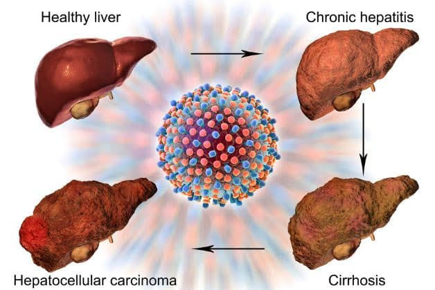 hepatitis-b-adults-body — HBV blood test HBsAg HBeAg HBV DNA antiviral treatment tenofovir entecavir monitoring