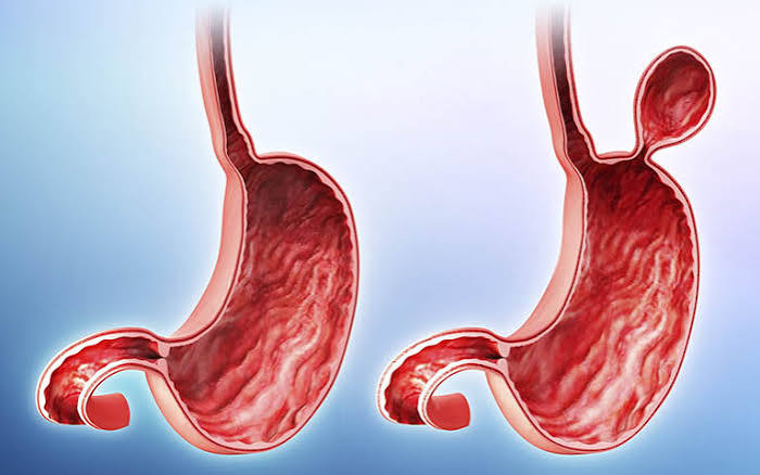 laparoscopic Nissen fundoplication hiatal hernia repair cruroplasty LINX anti-reflux surgery