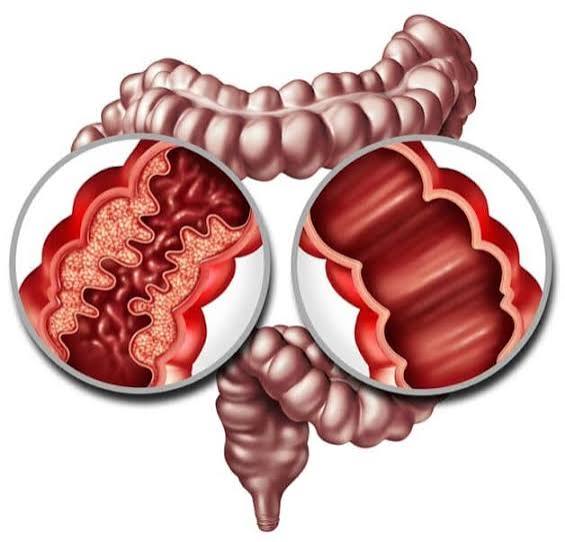IBD treatment pathway showing medical and surgical options for ulcerative colitis and Crohn's disease