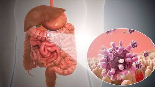 Inflammatory bowel disease diagram showing UC and Crohn's disease inflammation patterns in the gut