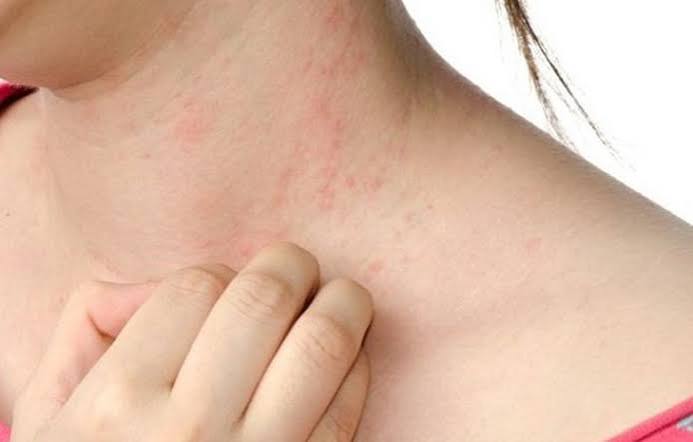 itchy-skin-and-liver-problems-body — cholestyramine rifampicin and naltrexone for cholestatic pruritus treatment