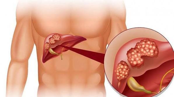 itchy skin and liver problems — cholestatic pruritus from bile duct disease and elevated bilirubin