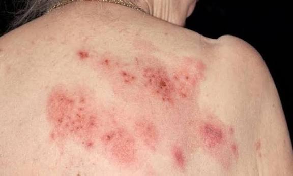 itchy skin kidney disease uremic pruritus CKD guide