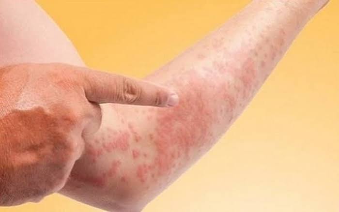 itchy skin kidney disease uremic pruritus phosphorus xerosis treatment options