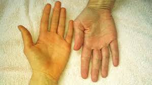 jaundice and bile flow problems yellow skin scleral icterus bilirubin obstructive hepatic pre-hepatic causes treatment