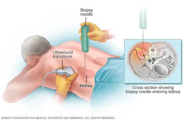 Kidney biopsy pathology results showing light microscopy immunofluorescence and electron microscopy for glomerular disease diagnosis