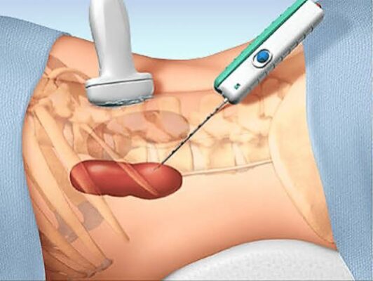 Kidney biopsy procedure showing percutaneous needle insertion under ultrasound guidance for glomerulonephritis diagnosis