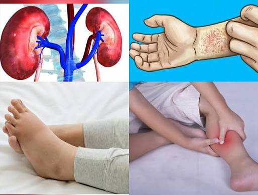 kidney disease and diabetes — diabetic nephropathy diagram showing glomerular damage from chronic high blood glucose in CKD