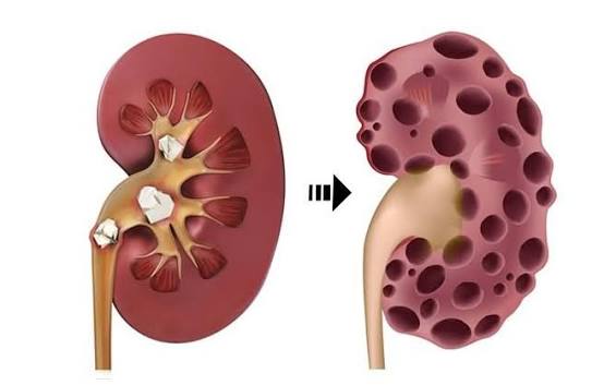 Diagram of how different kidney disease causes including diabetes and glomerulonephritis converge on interstitial fibrosis and tubular atrophy