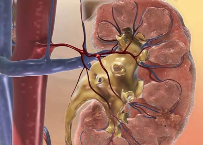 kidney failure treatment options — comparison diagram showing hemodialysis, peritoneal dialysis, and kidney transplant as treatment pathways