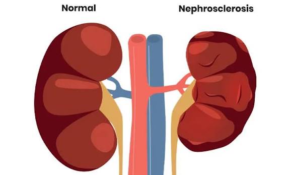 kidney failure treatment hemodialysis peritoneal dialysis kidney transplant comparison
