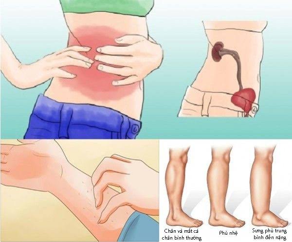 kidney infection symptoms and warning signs — person with flank pain indicating pyelonephritis with fever and chills