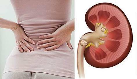 kidney stones symptoms causes and treatment — diagram showing kidney stone formation in kidney and passage through ureter causing severe flank pain