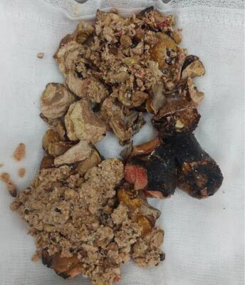 kidney stones symptoms causes and treatment — person holding lower back in pain from kidney stone with diagram showing stone in ureter