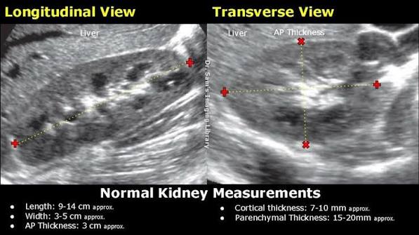 kidney ultrasound findings showing hydronephrosis grading posterior acoustic shadow from stone and Doppler flow