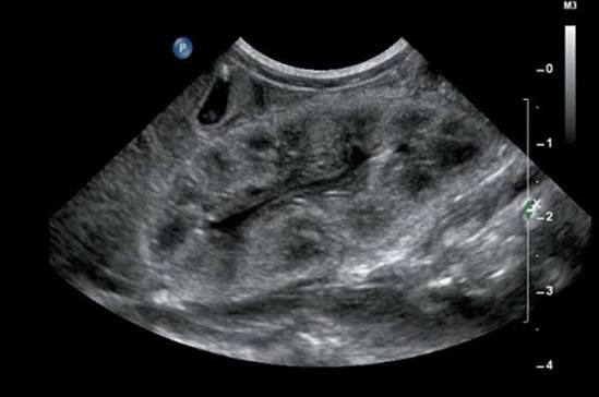 kidney ultrasound showing renal size cortex hydronephrosis and cysts for CKD diagnosis