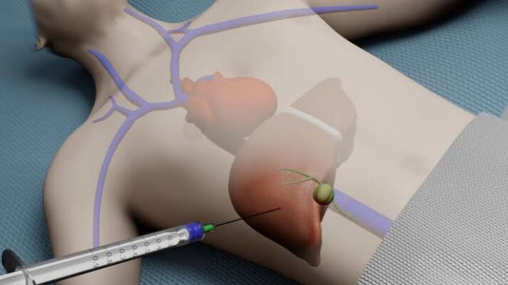 liver biopsy why it may be needed — percutaneous needle biopsy liver tissue histology fibrosis staging