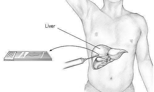 liver-biopsy-why-it-may-be-needed-body — liver biopsy histology slide Masson trichrome fibrosis staining