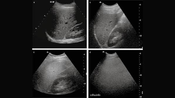 liver ultrasound when it may be used — fatty liver cirrhosis HCC surveillance hepatic mass focal lesion