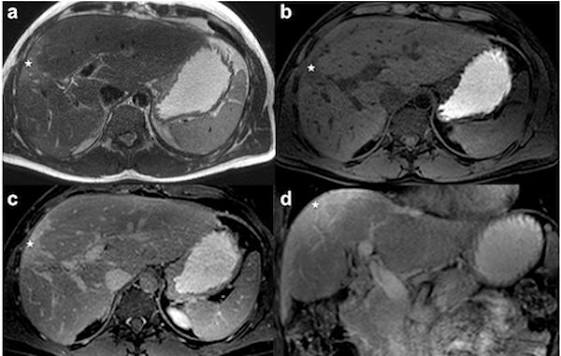 mri-for-liver-evaluation-body — MRCP magnetic resonance cholangiopancreatography bile duct gallstone biliary