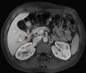 MRI for liver evaluation — hepatocellular carcinoma HCC LI-RADS gadoxetate MRCP liver lesion characterisation