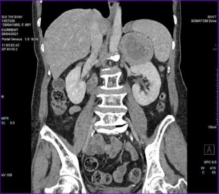 MRI for kidney evaluation showing renal mass gadolinium contrast enhancement and Bosniak cyst classification