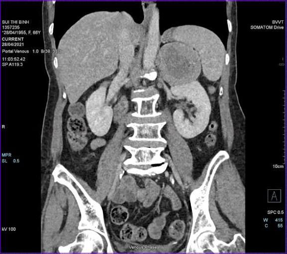 MRI for kidney evaluation showing renal mass gadolinium contrast enhancement and Bosniak cyst classification