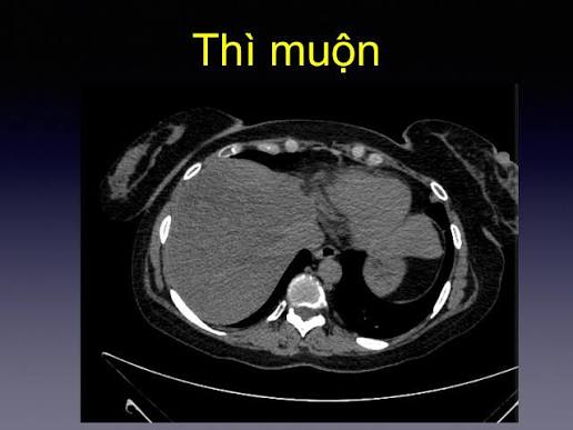 MRI kidney sequences showing T2 bright cyst gadolinium enhancement and Bosniak classification for renal mass characterization