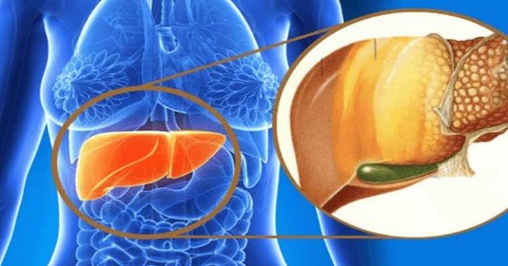 nonalcoholic fatty liver disease NAFLD MASLD explained metabolic steatosis liver cells hepatocytes