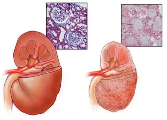 NSAIDs and kidney risk — ibuprofen naproxen diclofenac kidney damage risk for people with CKD