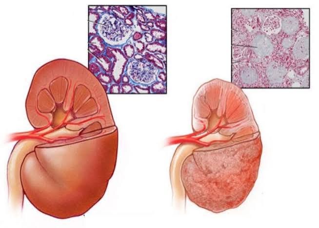 NSAIDs and kidney risk — ibuprofen naproxen diclofenac kidney damage risk for people with CKD