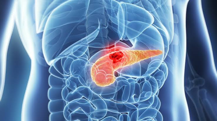 pancreatitis symptoms warning signs acute abdominal pain gallstones alcohol lipase severe necrotising