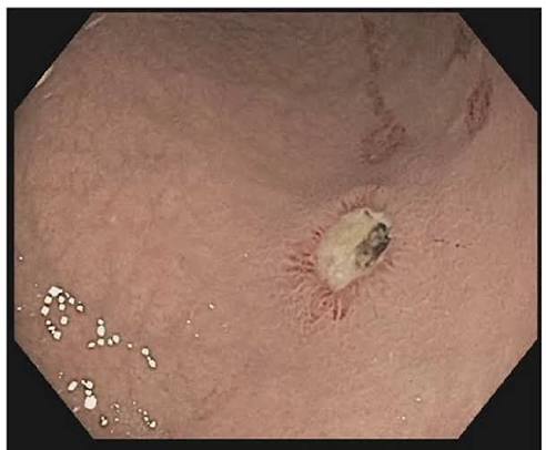 peptic ulcer disease gastric and duodenal ulcer causes treatment complications