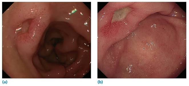 endoscopic haemostasis of bleeding peptic ulcer Forrest classification treatment