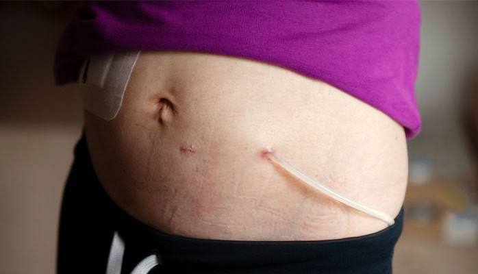 peritoneal dialysis explained — patient connecting PD catheter to dialysate bag for a home CAPD exchange