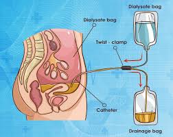 peritoneal dialysis explained — diagram of peritoneal cavity with catheter and dialysate filling the abdominal space for at-home kidney failure treatment