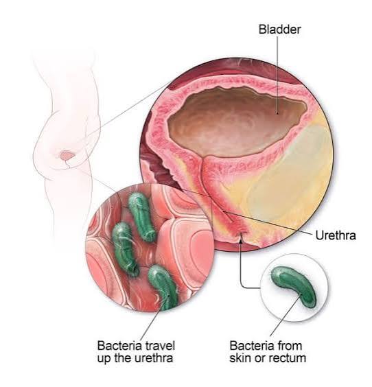 pregnancy and urinary health — diagram showing how the growing uterus, progesterone, and increased renal blood flow affect bladder function and UTI risk during pregnancy